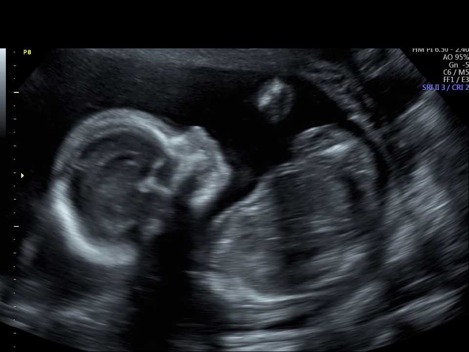 Baby Two Ultrasound